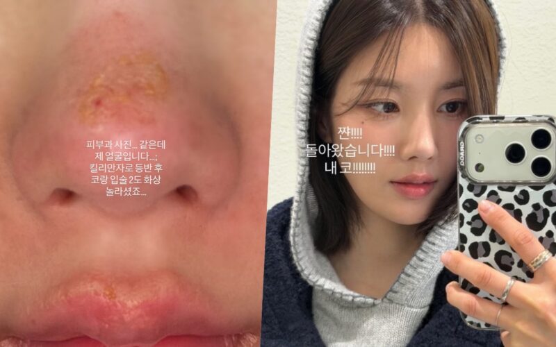 kwon eun bi face burns